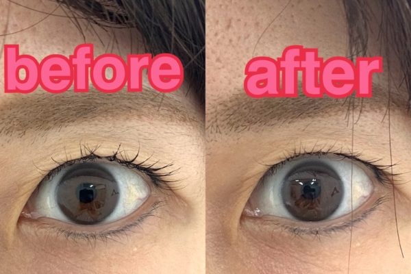 眼瞼下垂気味のまぶたの重さに美容鍼（ビフォーアフター写真あり）